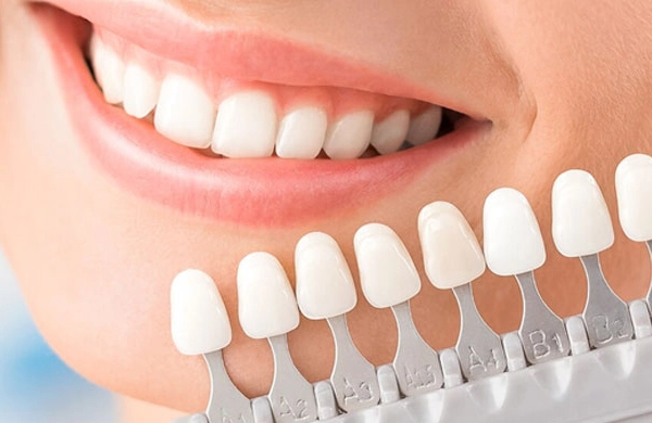 Facetas de Porcelana